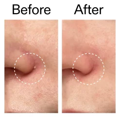 The Inkey List Hydrocolloid Invisible Pimple Patches 22 stk
